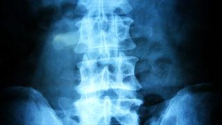 Bel fıtığı operasyonlarında felç kalma riski yok! 