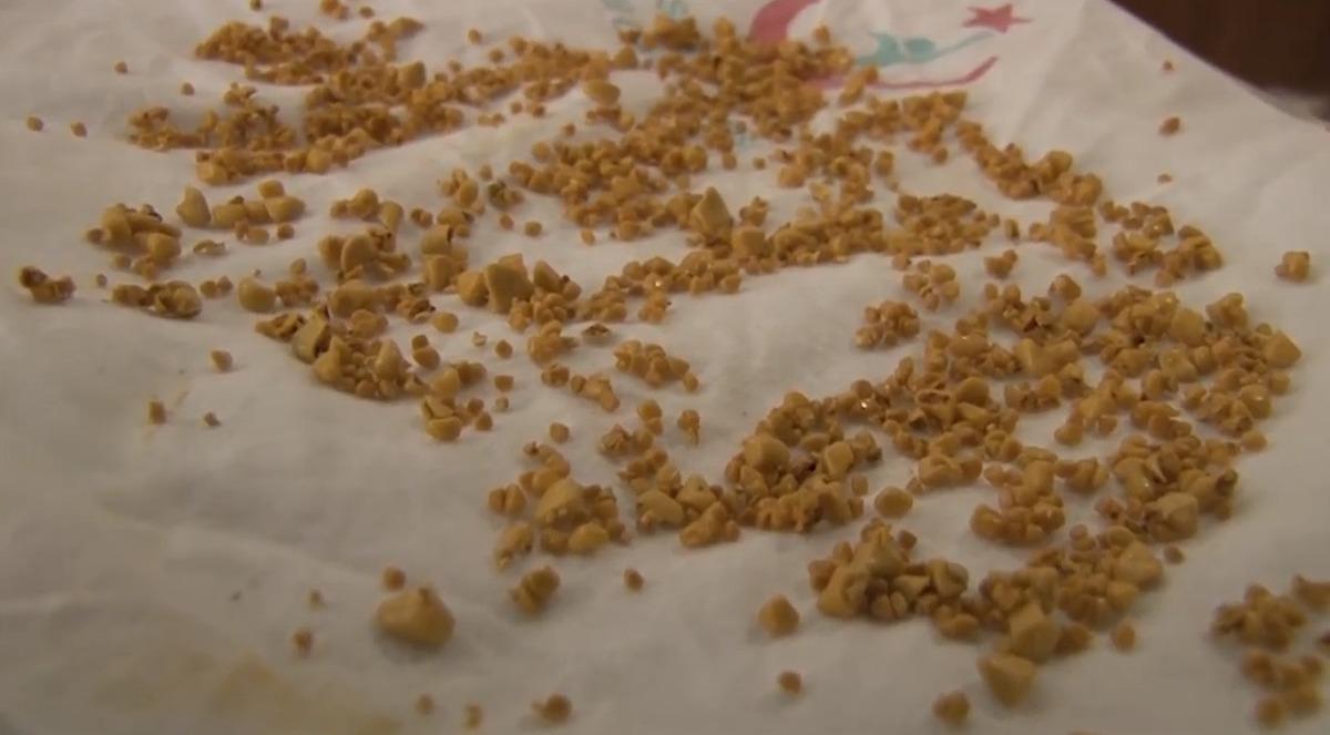 Karın ağrısı şikayetiyle ameliyata alınmıştı! '17 yıllık doktorum, b&ouml;ylesini g&ouml;rmedim'