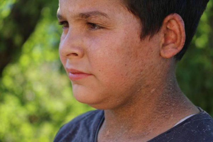 Turgutlu'daki 7 mahallede 'balık pulu' hastalığı! G2