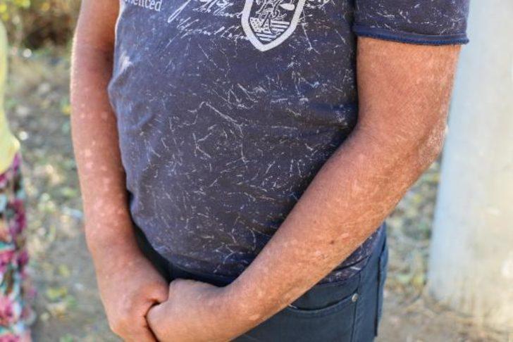 Turgutlu'daki 7 mahallede 'balık pulu' hastalığı! G1