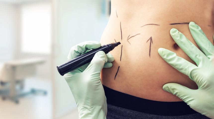 Laser Liposuction ile hayallerinizdeki vücuda kavuşun