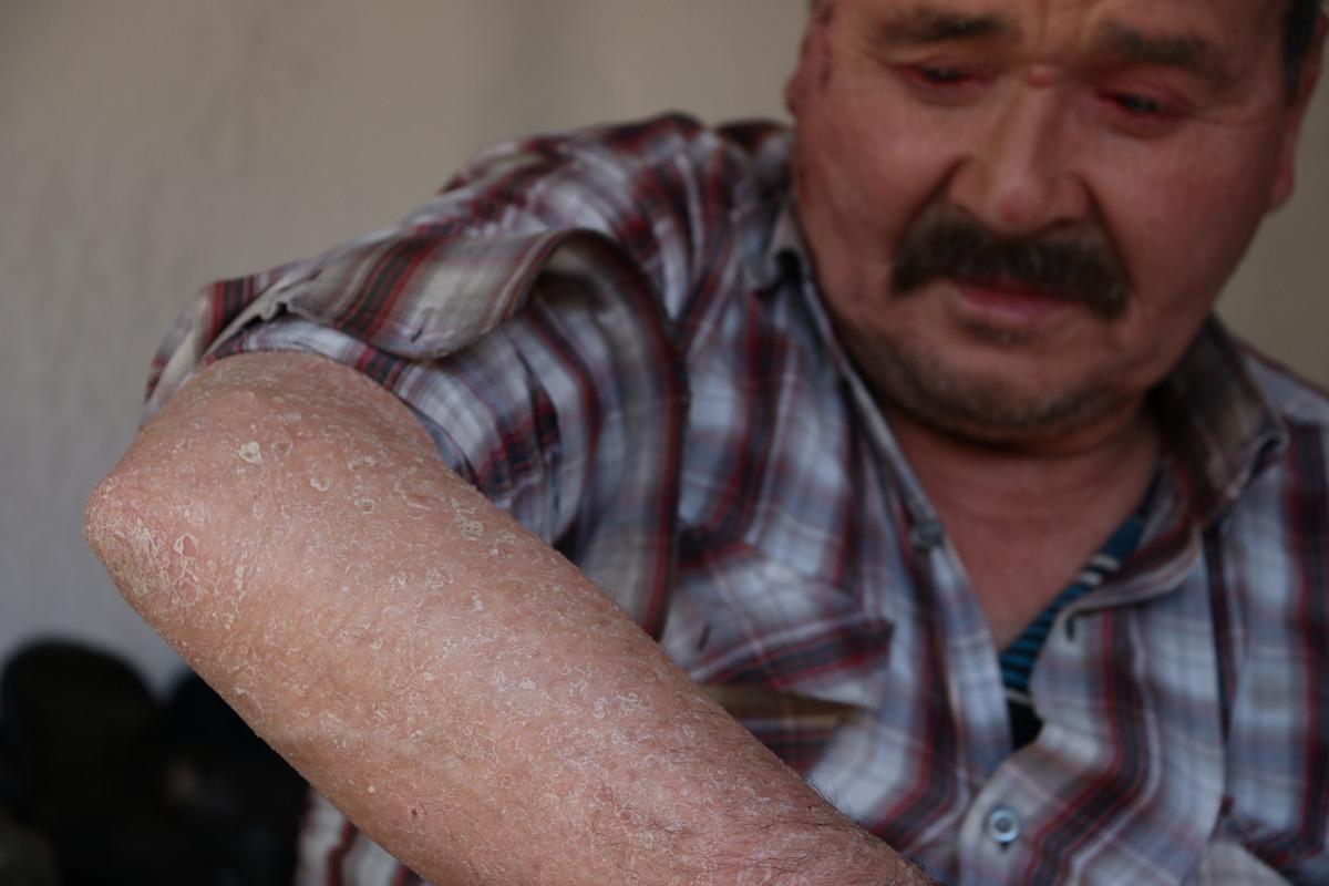 Bu hastalık 7 mahallenin kabusu oldu! 'Yemek yerken dışlandım, otob&uuml;se alınmadım'