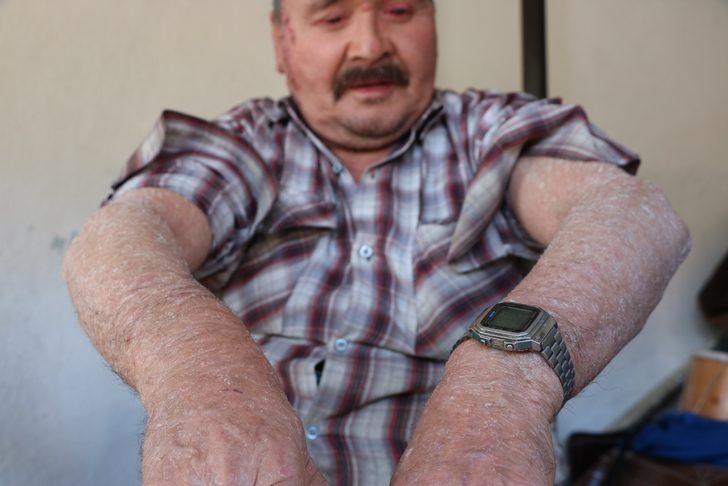 Bu hastalık 7 mahallenin kabusu oldu! 'Yemek yerken dışlandım, otobüse alınmadım' G1