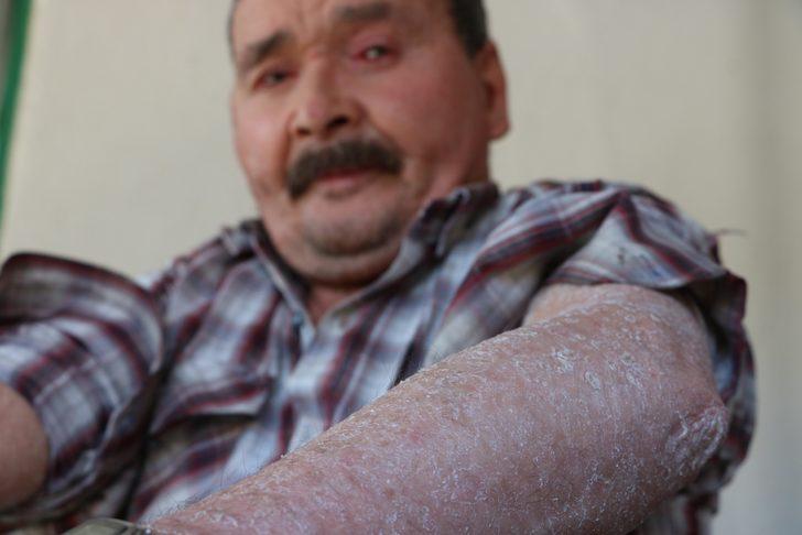 Bu hastalık 7 mahallenin kabusu oldu! 'Yemek yerken dışlandım, otobüse alınmadım' G2