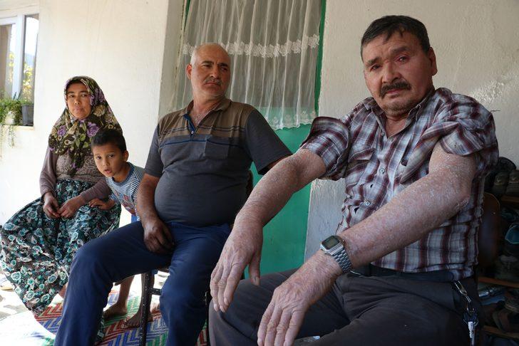 Bu hastalık 7 mahallenin kabusu oldu! 'Yemek yerken dışlandım, otobüse alınmadım' G3