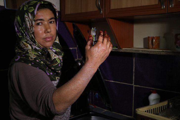 Bu hastalık 7 mahallenin kabusu oldu! 'Yemek yerken dışlandım, otobüse alınmadım' G5