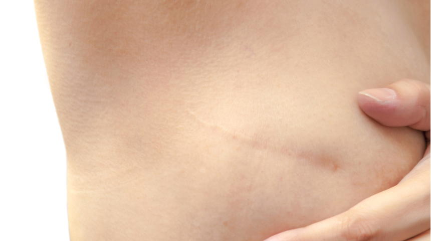 T&uuml;rkiye&rsquo;de meme kanseri &ccedil;ok gen&ccedil; yaşlarda da g&ouml;r&uuml;l&uuml;yor, en gen&ccedil; hasta 17 yaşında!