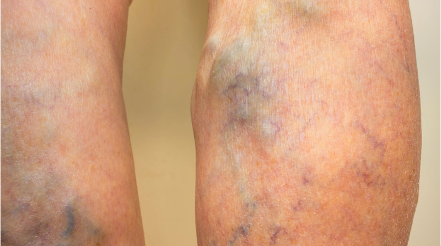 Bu faktörler varisi tetikliyor