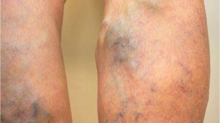 Bu faktörler varisi tetikliyor