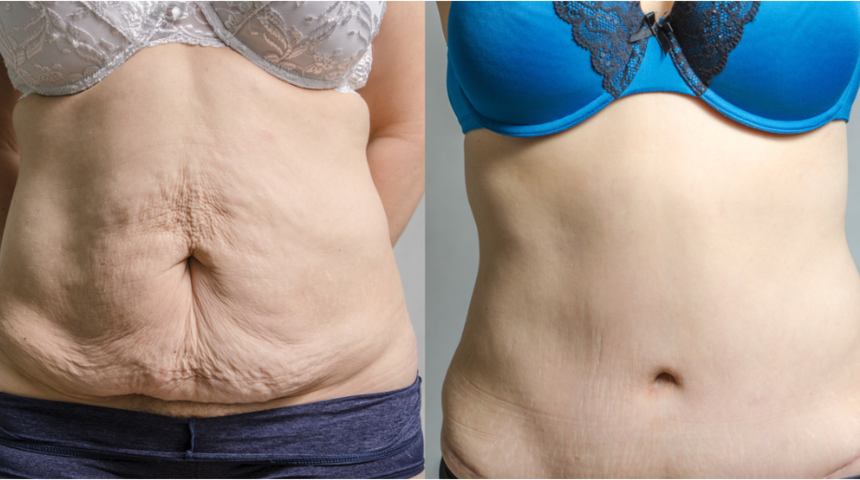 Vücut estetiğinde yeni bir teknoloji! J –Plasma nedir?