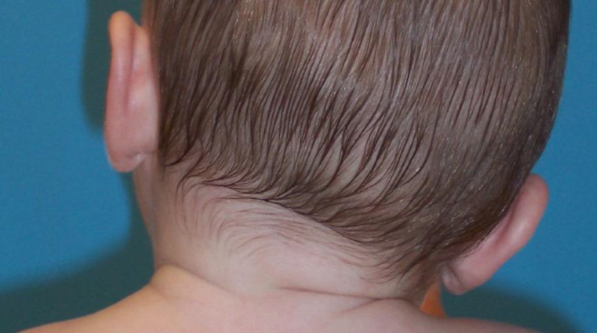 Bebeklerin sırt üstü yatırılması eğri boyun sebebi 