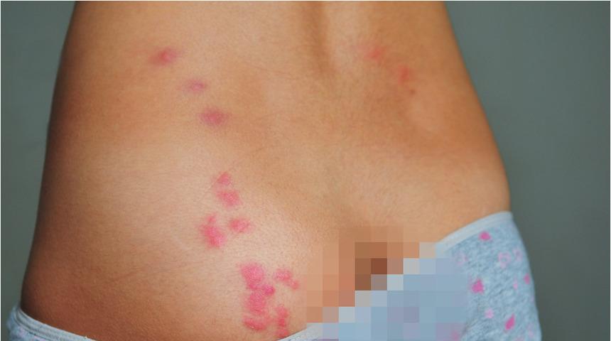 Herkesi ilgilendiriyor! B&ouml;cek ısırıkları ne anlama geliyor?