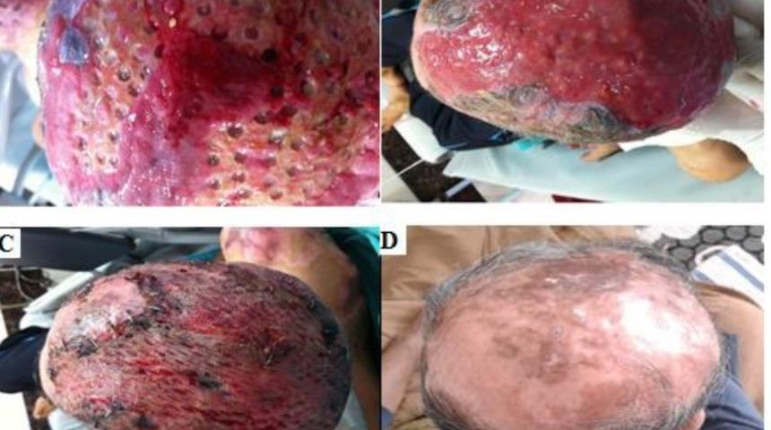 25 Aralık Devlet Hastanesi yanık merkezi bir ilk başardı