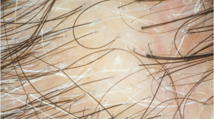 Erkekler kadar kolay olmuyor! Kadınlar sa&ccedil; d&ouml;k&uuml;lme sorununu daha ağır yaşıyor