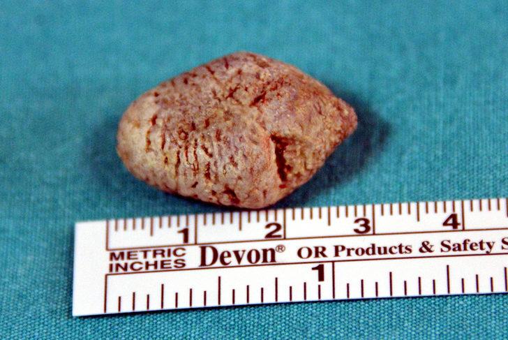 Tükürük bezinden taş çıktı! Doktor bile şaşırdı: Bu kadar büyük beklemiyordum G2