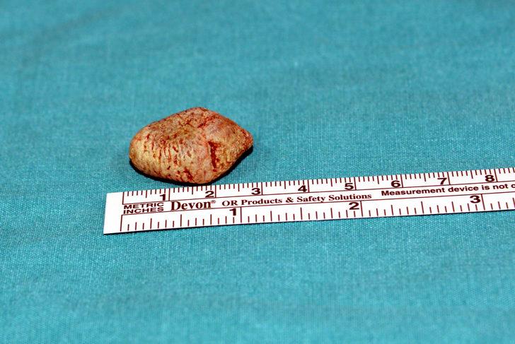 Tükürük bezinden taş çıktı! Doktor bile şaşırdı: Bu kadar büyük beklemiyordum G3