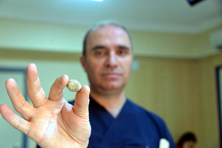 Tükürük bezinden taş çıktı! Doktor bile şaşırdı: Bu kadar büyük beklemiyordum G4