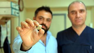 Tükürük bezinden taş çıktı! Doktor bile şaşırdı: Bu kadar büyük beklemiyordum