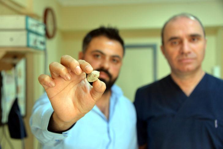 Tükürük bezinden taş çıktı! Doktor bile şaşırdı: Bu kadar büyük beklemiyordum G5