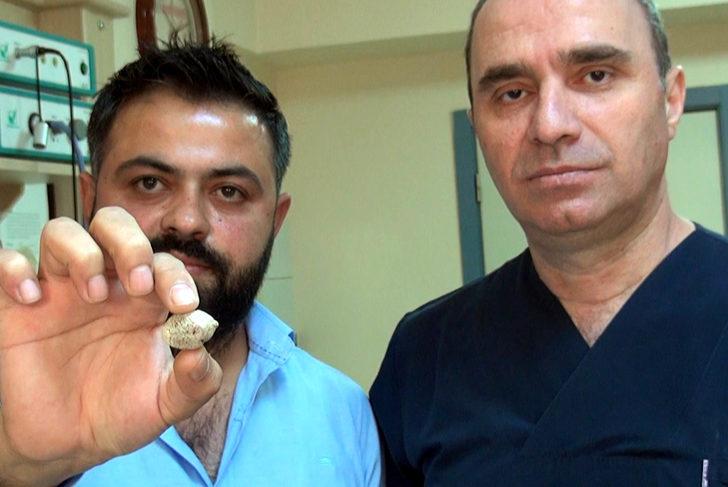 Tükürük bezinden taş çıktı! Doktor bile şaşırdı: Bu kadar büyük beklemiyordum G1