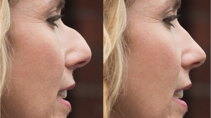 Burun estetiği kadında farklı erkekte farklı mı yapılıyor? 
