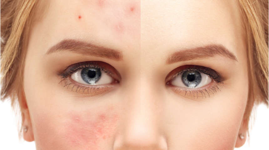 Sivilcelere ilaçsız çözüm mümkün!