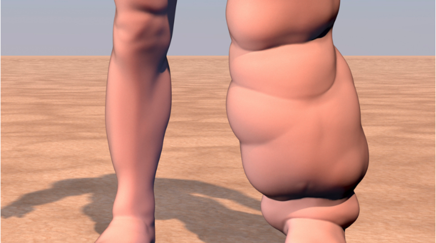 Sıkan ayakkabı ve takılara dikkat! Fil hastalığı bir diğer adıyla Lenfödem belirtisi olabilir