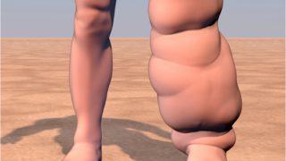 Sıkan ayakkabı ve takılara dikkat! Fil hastalığı bir diğer adıyla Lenfödem belirtisi olabilir