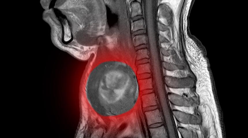 Şah damarı tümörü çocuklarda da görülüyor