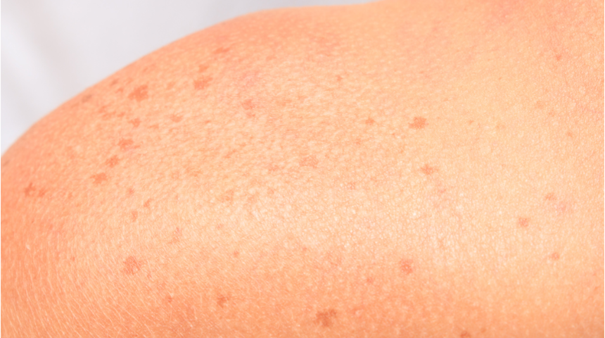 Güneş lekelerinden kurtulmanın püf noktaları