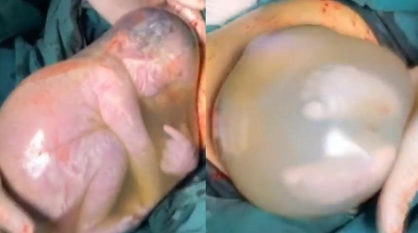 100 binde bir görülen mucizeye tanık olun! Amniyotik kese içinde doğum anı 