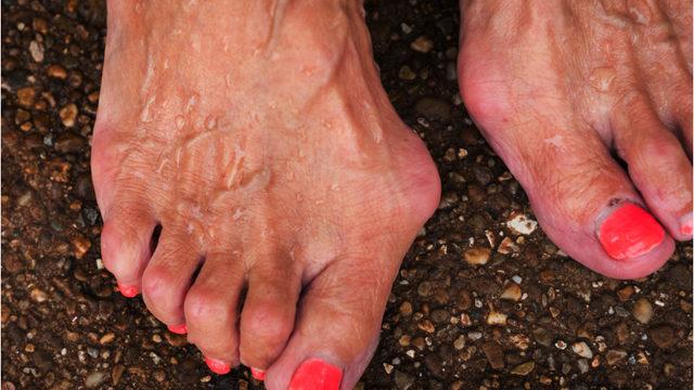 Ayakkabı seçimine dikkat: Kadınların yüzde 40’ı bu hastalıkla mücadele ediyor