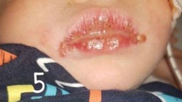 Ölüm öpücüğü! 'Bebeklerinizi uçuğu olan kişilere öptürmeyin'