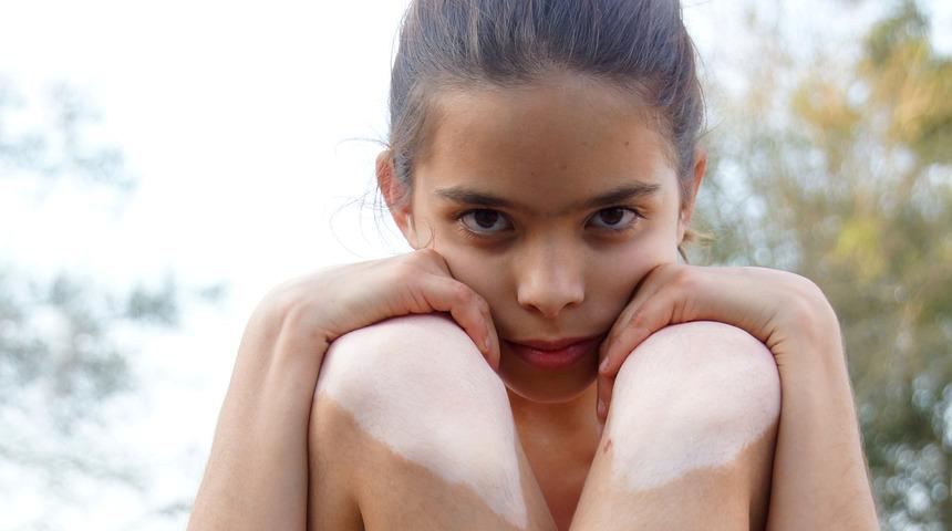 Çocukluk çağı vitiligo'sunda immünoterapinin önemi