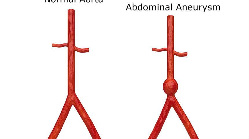 Karnınızdaki saatli bomba: Aort anevrizması! Aort anevrizması nedir? Aort anevrizması belirtileri ve tedavisi nelerdir? 