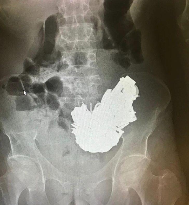 Doktorlar bile şaşırdı! İzmir'de 680 gram metal yutan kişi hayatını kaybetti G3