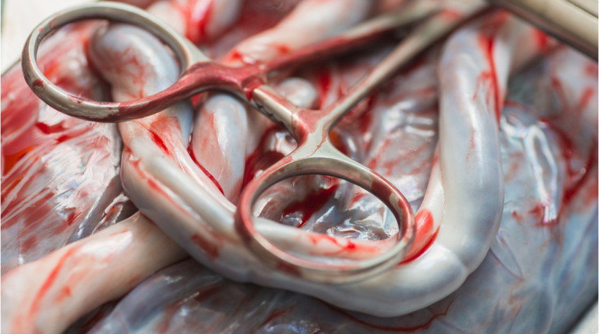 Bebeğin g&ouml;bek bağının ge&ccedil; kesilmesi hayat kurtarıyor 