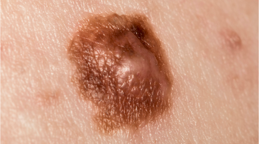 Ayağınızın altı, elinizin içi kaşınıyorsa dikkat!  Benler cilt kanseri habercisi olabilir