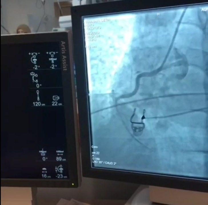 Kurulumu tamamlanan “3. Basamak Kalp Damar Yoğun Bakım Ünitesi”nde ilk anjiyo yapıldı G4