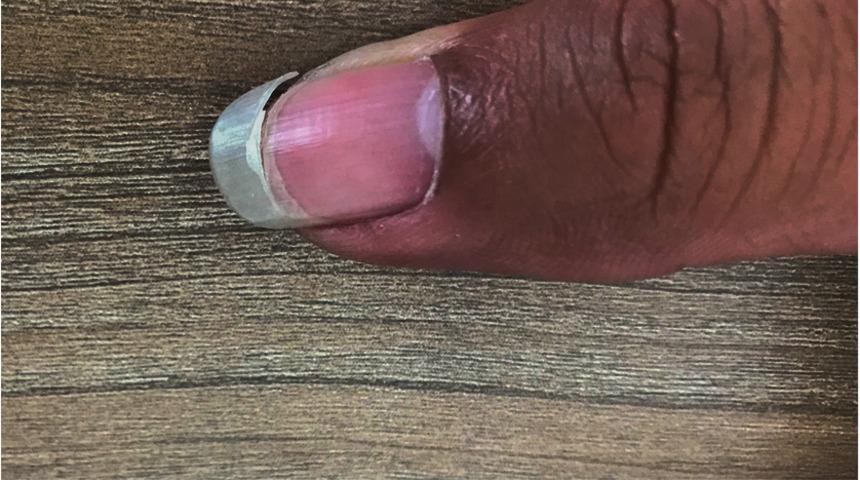 Kansızlık hastalığı, en çok kadınları etkiliyor