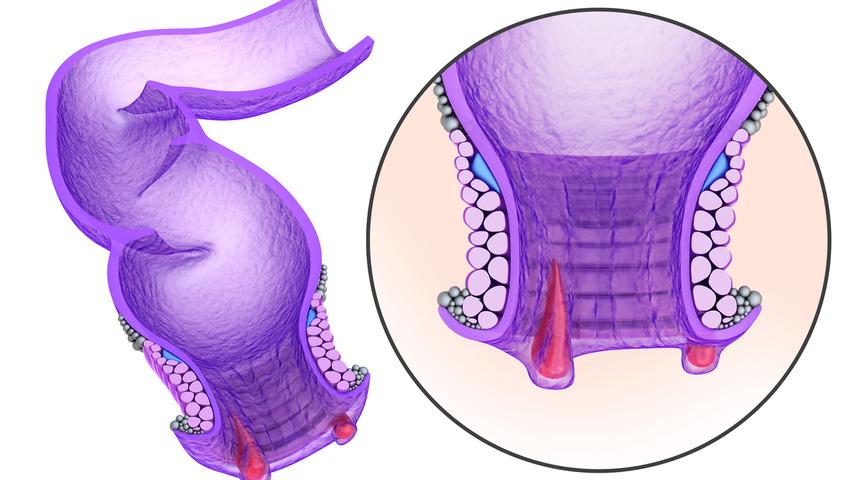 Anal fistül nedir? Anal fistül tedavisinde lazer yöntemi