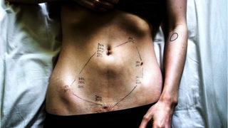 Endometriozis ile yaşamanın yıkıcı gerçekliği ve acı veren fotoğrafları