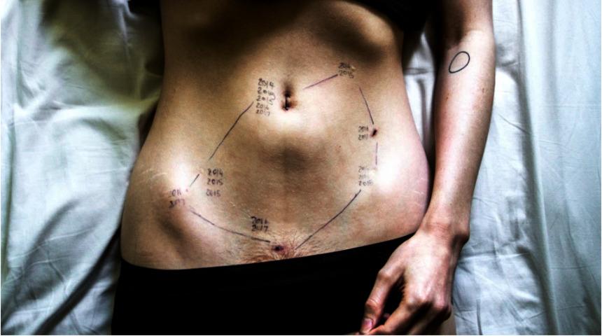 Endometriozis ile yaşamanın yıkıcı gerçekliği ve acı veren fotoğrafları