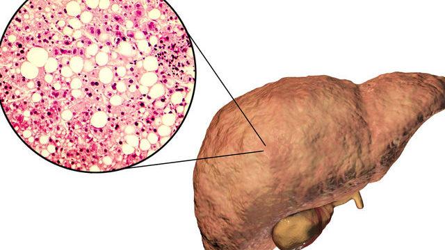 Karaciğer sağlığı için beslenme: Karaciğer sağlığı için ne yemeli?
