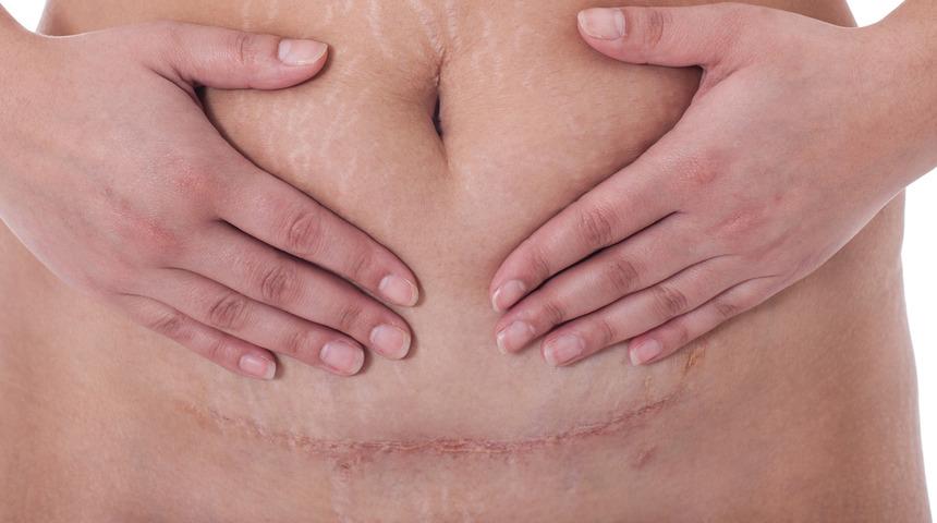 Sezaryen, bebeklerin bağırsak sağlığını tehdit ediyor