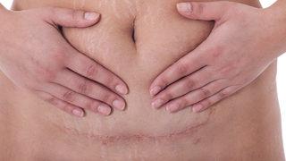 Sezaryen, bebeklerin bağırsak sağlığını tehdit ediyor