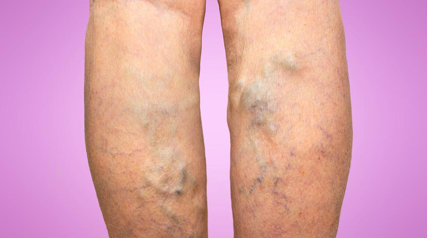 Varis nedir? Varis tedavisi nasıl olur? Varisi olanlar bunlara dikkat 