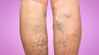 Varis nedir? Varis tedavisi nasıl olur? Varisi olanlar bunlara dikkat 