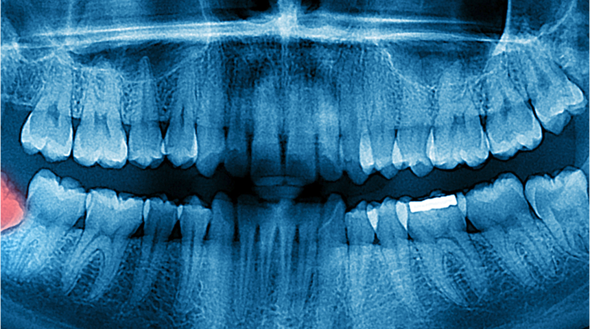 Hamilelik döneminde diş röntgeni tehlikeli mi?
