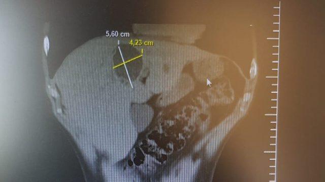 Karaciğerideki kistten 3 saatlik operasyonla kurtuldu
